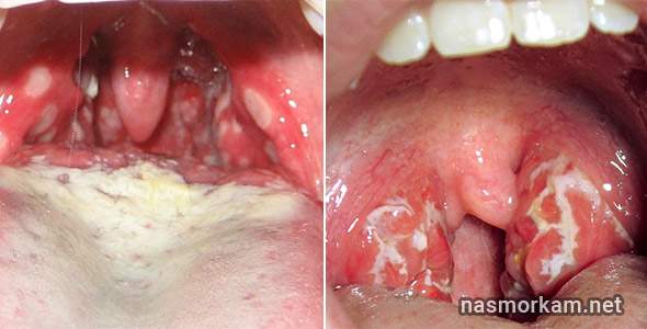 горло болит и отекло глотать больно лечение