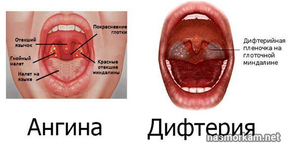 горло болит и отекло глотать больно лечение