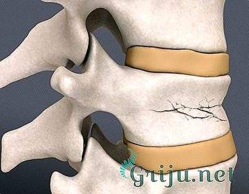 как лечат компрессионный перелом позвоночника в европе