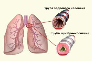 как снять отек бронхов в домашних условиях