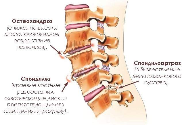 как снять отек нервного корешка в спине