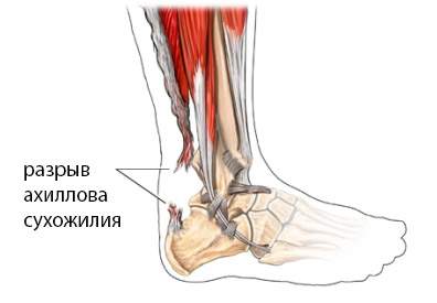 как снять отек после операции на ахилловом сухожилии