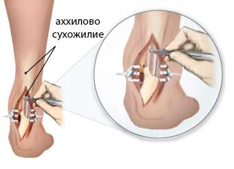 как снять отек после операции на ахилловом сухожилии