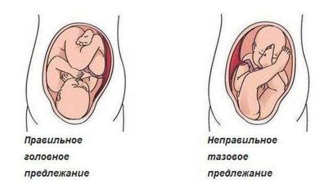 коленно локтевая позиция при беременности от отеков