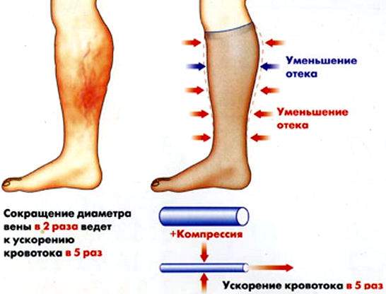 лимфостаз нижних конечностей чем грозят отеки ног