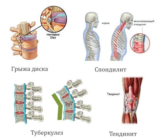 можно ли греть перелом ноги в гипсе