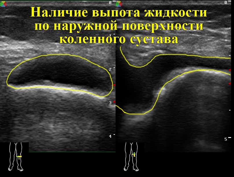 опухло колено без ушиба и болит как