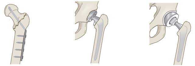 Перелом шейки бедра операция. Гемиартропластика тазобедренного сустава при переломе шейки бедра. Эндопротезирование тазобедренного сустава при переломе шейки бедра. Гемиартропластика тазобедренного сустава при переломе шейки.