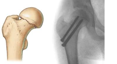 остеосинтез или эндопротезирование при переломе шейки бедра