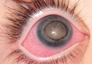 отек белка глаза что делать чем лечить