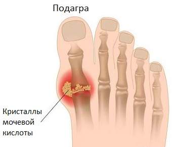 отек большого пальца на ноге как лечить