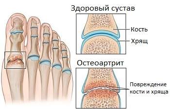 отек большого пальца на ноге как лечить