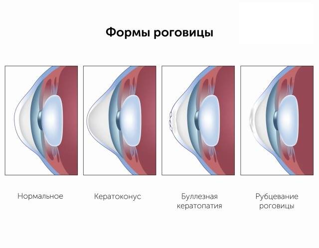 отек эпителия роговицы является одним из симптомов