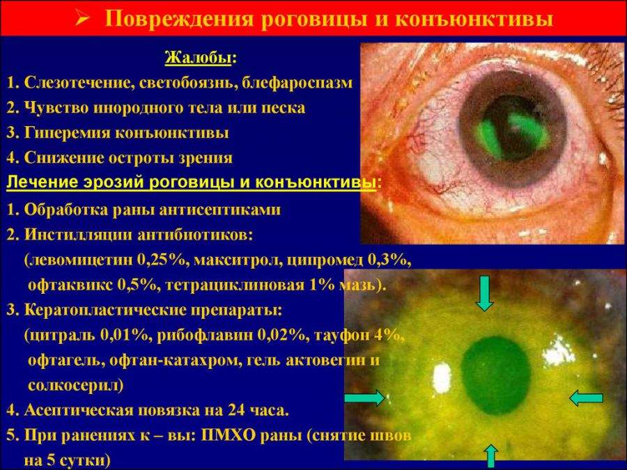 отек эпителия роговицы является одним из симптомов