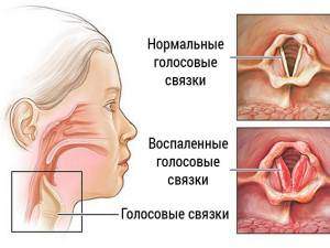 отек гортани симптомы и лечение у взрослых