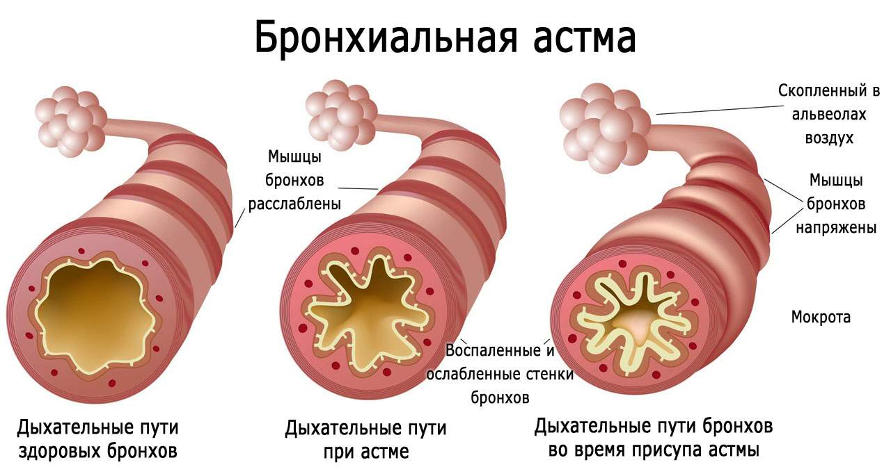 отек легких и сердечная астма дифференциальная диагностика