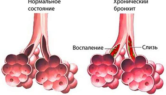 отек легких и сердечная астма дифференциальная диагностика