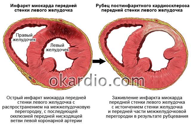 отек легкого при болезни сердца постинфарктный кардиосклероз