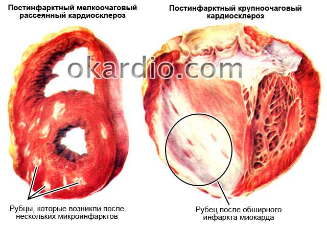 отек легкого при болезни сердца постинфарктный кардиосклероз