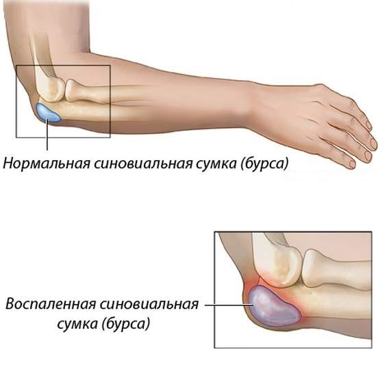 отек локтевого сустава лечение в домашних условиях