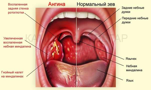 отек миндалин у детей без температуры лечение