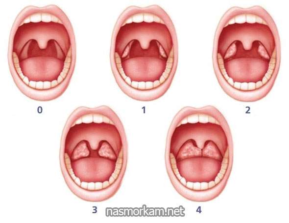 отек миндалин у детей без температуры лечение