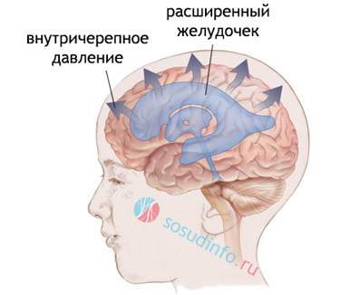 отек мозга при метастазах в головной мозг