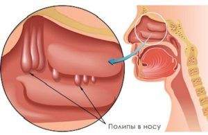 отек носоглотки без насморка лечение народными средствами