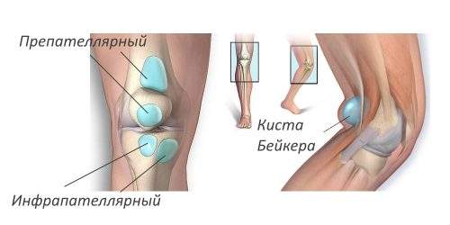 отек под коленом с внутренней стороны без боли