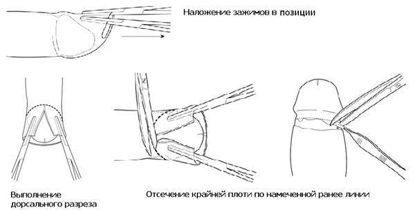 отек после обрезания крайней плоти у мужчин обработка