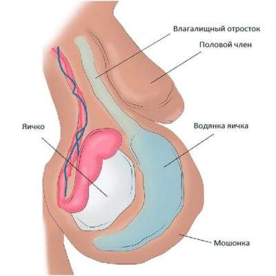 отек после операции водянки яичка у ребенка