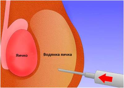 отек после операции водянки яичка у ребенка