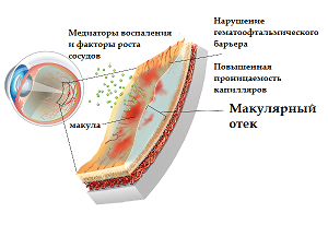 отек сетчатки глаза лечение в домашних условиях