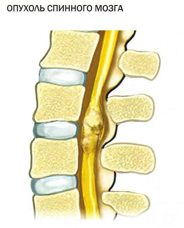 отек спинного мозга позвоночника что это такое