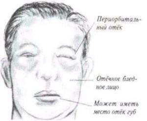 отеки при остром гломерулонефрите с нефротическим синдромом