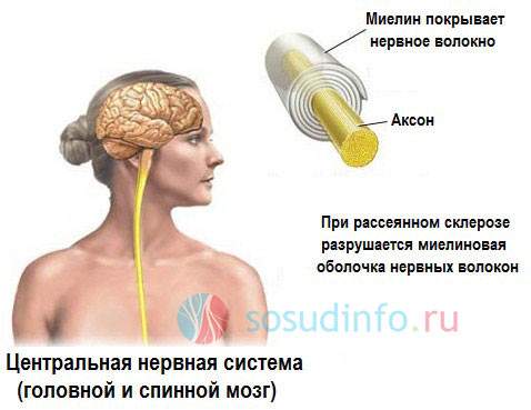 отеки при рассеянном склерозе из за чего