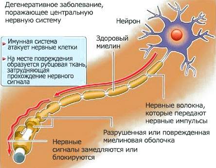 отеки при рассеянном склерозе из за чего