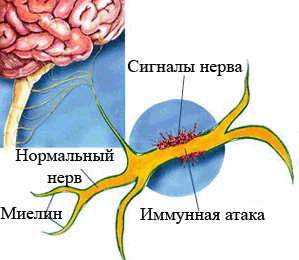 отеки при рассеянном склерозе из за чего