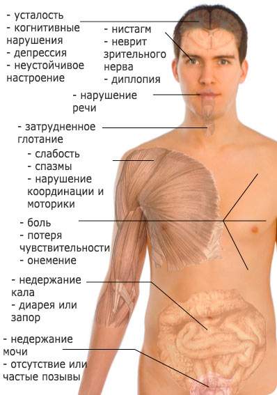 отеки при рассеянном склерозе из за чего