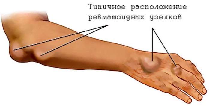 отекли кисти рук и болят что делать