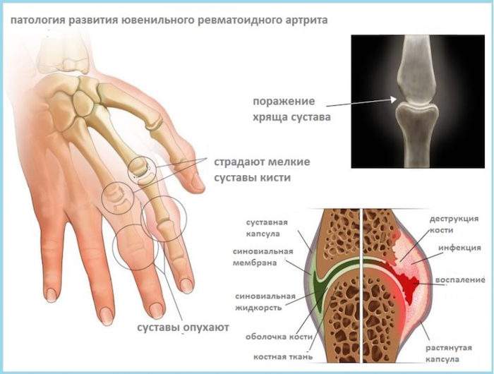 отекли кисти рук и болят что делать