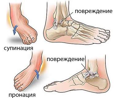 перелом лодыжки со смещением нужна ли операция