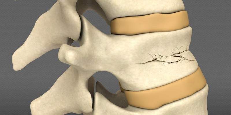 перелом позвоночника с разрывом спинного мозга последствия