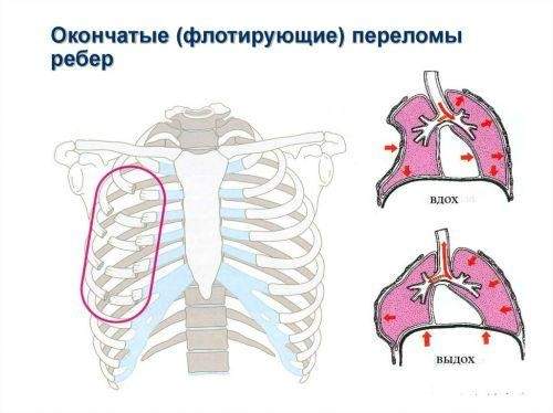 перелом ребра грудной клетки симптомы и лечение