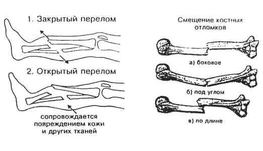 перелом руки со смещением операция сколько стоит