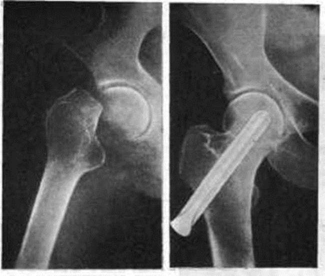 Перелом шейки бедра лечение операции. Оскольчатый перелом шейки бедра рентген. Аддукционный перелом шейки бедра. Варусный перелом шейки бедра рентген. Трансцервикальный перелом шейки бедра рентген.
