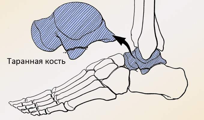 перелом таранной кости сколько ходить в гипсе