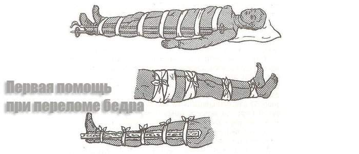 правила оказания помощи при переломе бедренной кости