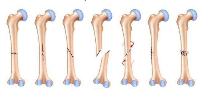 правила оказания помощи при переломе бедренной кости