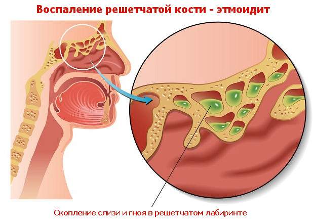 пристеночный отек слизистой оболочки ячеек решетчатого лабиринта